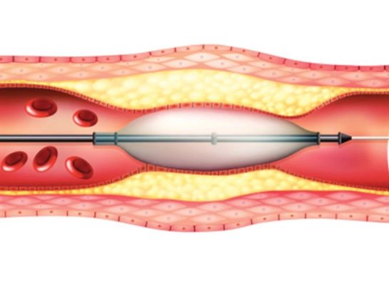 Angioplasty Procedure by Dr Vinod Kumar K in Bangalore