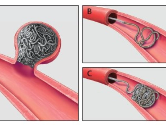 Coil Embolization by Dr Vinod Kumar K in Bangalore