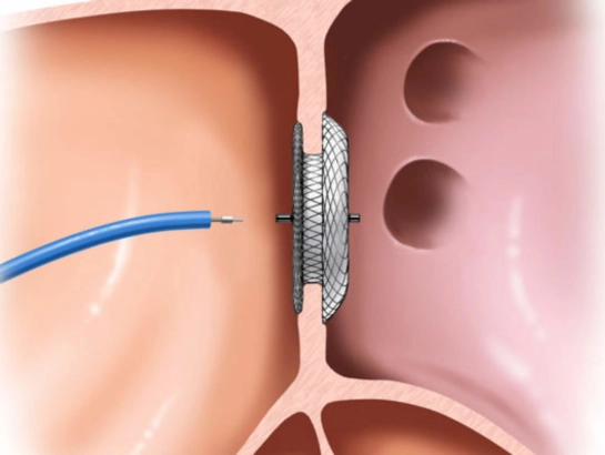 Device Closures for Adult and Pediatric Patients by Dr Vinod Kumar K in Bangalore