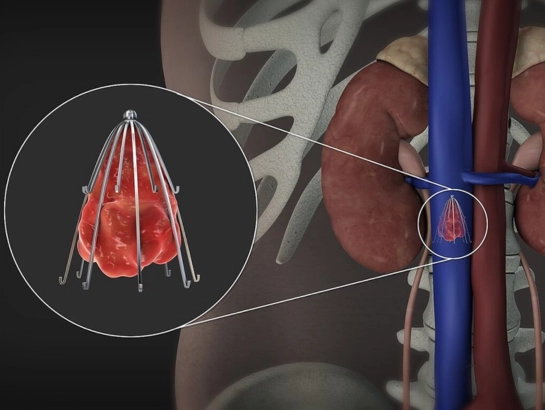 IVC Filters by Dr Vinod Kumar K in Bangalore