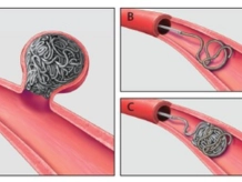 Coil Embolization Procedure - Dr. Vinod Kumar K