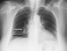 Pulmonary Embolism Causes and Treatment - Dr. Vinod Kumar K